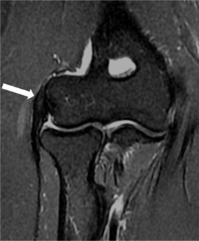 01-irm-epicondylite-laterale-signal-tendon-extenseur