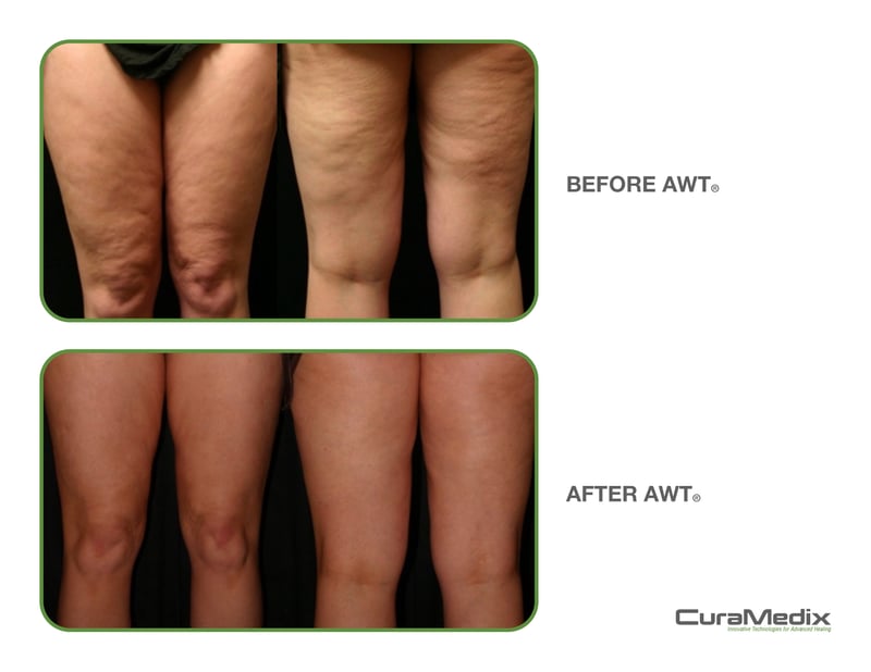 AWTBeforeandAfters_Cellulite