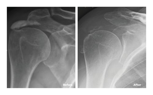 Before-After-DeNoble
