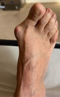 EMTT and Bunion Relief - Up close photo of a bunion