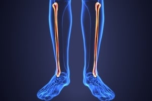 Extracorporeal Shock Wave Therapy for Tibial Nonunion  