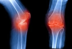 X-ray film of a knee with osteoarthritis, showing both anterior-posterior (AP) and lateral views. The images reveal a narrowed joint space indicative of cartilage degradation typical in osteoarthritis.