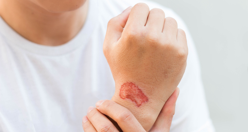 FEATURED - Revolutionizing Wound Care - Access Our New Wound Healing Resource Hub